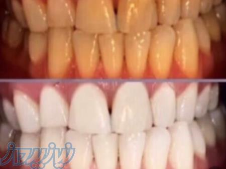 تخفیف ویژه بلیچینگ و جرمگیری و پالیش 