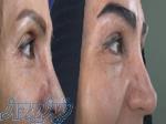 کاشت مو و ابرو با پرداخت 8 تومن و قسطی 
