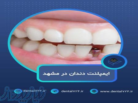 ایمپلنت دندان در مشهد  با اقساط بلندمدت و شرایط ویژه 