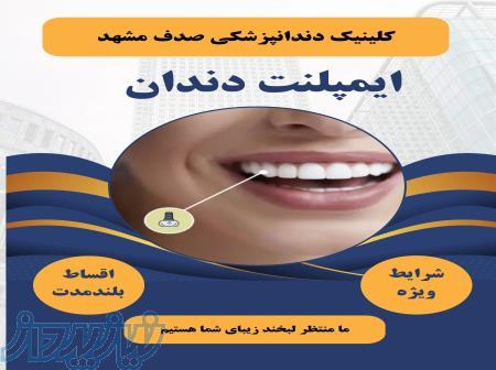 ایمپلنت دندان در مشهد با اقساط بلند مدت، بدون پیش پرداخت ( دیگه نگران هزینه‌ها نباش ) 