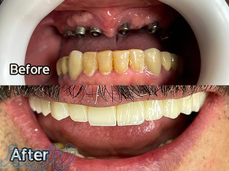 لمینت بدون تراش 