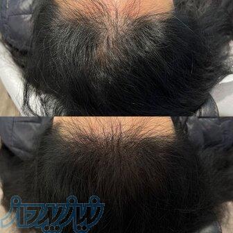 میکرواسکالپ سر 