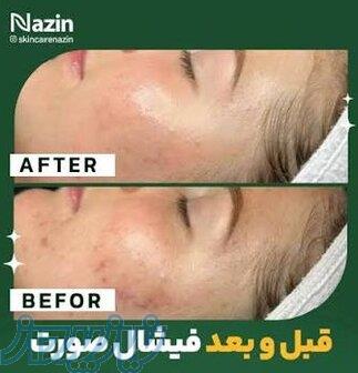 فیشال و پاکسازی پوست و صورت نازین در ارومیه 