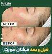فیشال و پاکسازی پوست و صورت نازین در ارومیه 