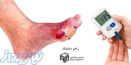 درمان زخم دیابتی   کلینیک بهبودان 