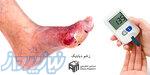 درمان زخم دیابتی   کلینیک بهبودان 