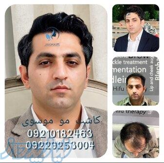 کاشت مو با تخفیف ویژه 