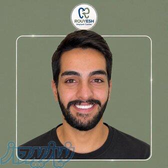 ایمپلنت با اقساط طولانی مدت 