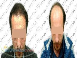 كاشت و ترميم مو