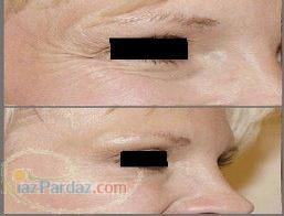 لیفت صورت بدون جراحی پلاستیک بدون خونریزی یا زخم