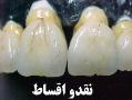 ساخت دندان مصنوعی فقط با 70 هزار تومان