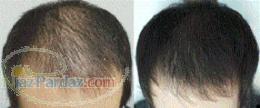 مزوتراپی بیولژیک PRP موثرترین روش درمان ریزش مو