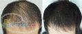 مزوتراپی بیولژیک PRP موثرترین روش درمان ریزش مو