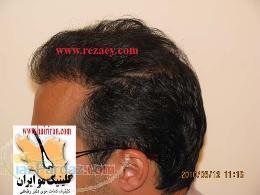 کاشت مو با نازلترین قیمت