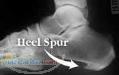 درمان خار پاشنه (Heel Spur) بدون جراحی در یک جلسه