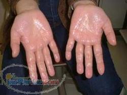 دستگاه کاهش تعریق بدن آیا از تعریق خیلی زیاد