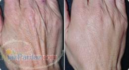 جدیدترین روش جوانسازی دست