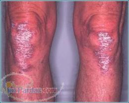 داروی psoraisis-پسوریزیس