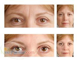 تزریق بوتاکس -شیراز
