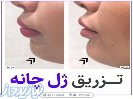 تزريق بوتاكس ، درمان ريزش مو