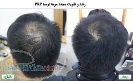 کلینیک ایران پوست کاشت مو با PRP رایگان