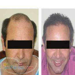 مركز پيوند موي طبيعي دكتر علي قاسمي