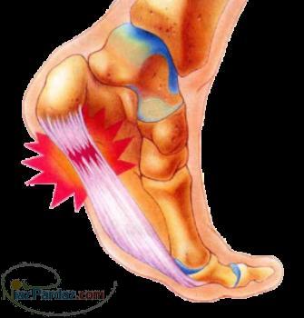 درمان خار پاشنه در یک جلسه