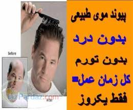 جدیدترین روش کاشت مو بدون درد - دکتر صداقت