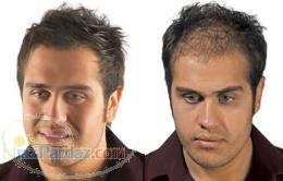 پودر پر پشت کننده موی سر مورست 12 5 گرمی