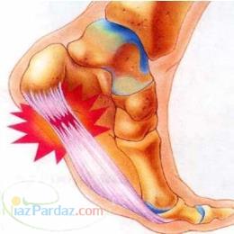 درمان قطعي خار پاشنه فقط با ٥ جلسه درمان