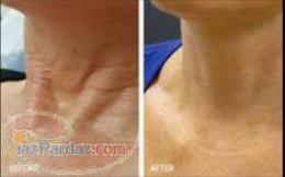 Super PRP درمان تعریق زیر بغل  تزریق ژل و چربی گونه بوتاکس آکنه و لکهای مقاوم به درمان ریزش مو 