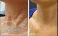 Super PRP درمان تعریق زیر بغل  تزریق ژل و چربی گونه بوتاکس آکنه و لکهای مقاوم به درمان ریزش مو 