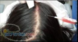 Super PRP درمان تعریق زیر بغل  تزریق ژل و چربی گونه بوتاکس آکنه و لکهای مقاوم به درمان ریزش مو 