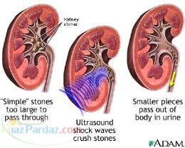 سنگ شکنی کلیه شبانه روزی 
