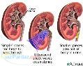 سنگ شکنی کلیه شبانه روزی 