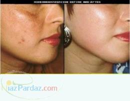 رفع جای جوش وجوانسازی 