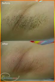 لیزر موهای زاید صورت و بدن با پیشرفته ترین دستگاه آی پی ال 