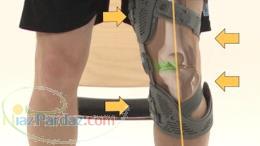 درمان جدید آرتروز زانو 