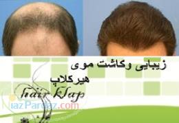 کاشت مو کاشت ابرو hairklap 