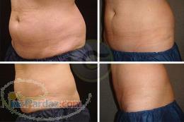 لاغری موضعی با کرایولیپولیز در مطب دکتر فرهانی 