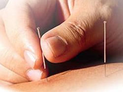 کلینیک طب سوزنی  - تهران