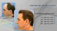 کلینیک کاشت مو ایران بیوتی 