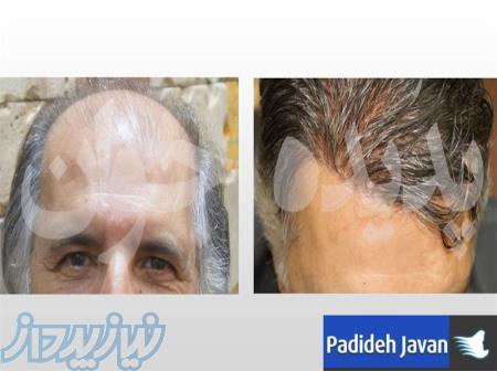 ییوند مو به روش HRP ، قیمت پیوند موی سر