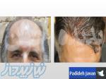 ییوند مو به روش HRP ، قیمت پیوند موی سر