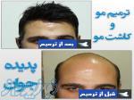 بزرگترین مرکز ترمیم مو در تهران - آلوپسی آره آتا