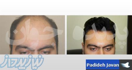 بزرگترین مرکز ترمیم مو و کلینیک تخصصی ترمیم موی پدیده جوان