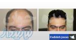 بزرگترین مرکز ترمیم مو و کلینیک تخصصی ترمیم موی پدیده جوان