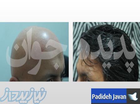 خدمات ترمیم مو و کاشت تار به تار مو پدیده جوان