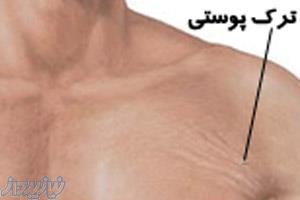 درمان قطعی ترک های پوستی برای اولین بار در ایران