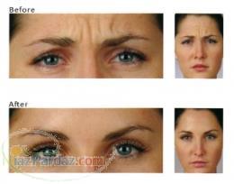 فروش بوتاکس و ژل اصل با قیمت عالی 